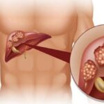 Махны хэрэглээнээс үүдсэн төмрийн илүүдэл элгийг гэмтээдэг